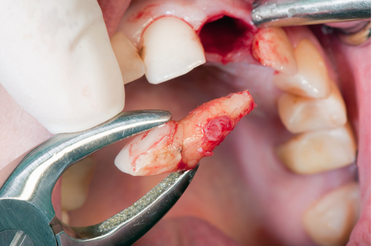 Impacted Tooth Extractions & Surgery